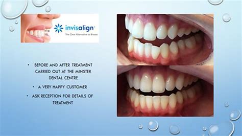 Usually, they'll suggest that you wear your retainers for up to six months after your treatment is over. Invisalign GO - Minster Dental Centre