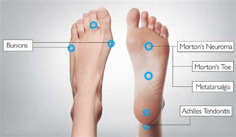 Foot Pain Diagnosis Diagram