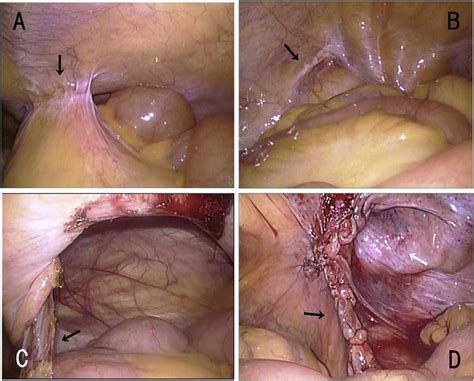 Laparoscopic Findings A The Mesentery Of The Small Intestine Is