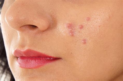 Blind Pimples Causes Prevention And Home Remedy
