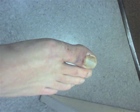 Toe Crushed Fracture Injury Flickr Photo Sharing