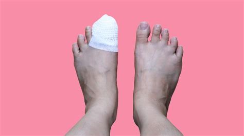 Hammertoe Surgery Before And After