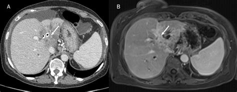 Ct A And Mri B Portal Phase Assessment Of Icc The Typical Contrast