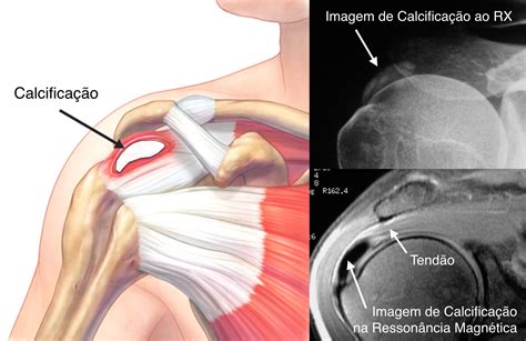 Tendinite calcária no Ombro tendinite calcificada Ortopedista em