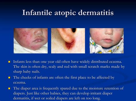 Ppt Atopic Dermatitis Powerpoint Presentation Free Download Id634155