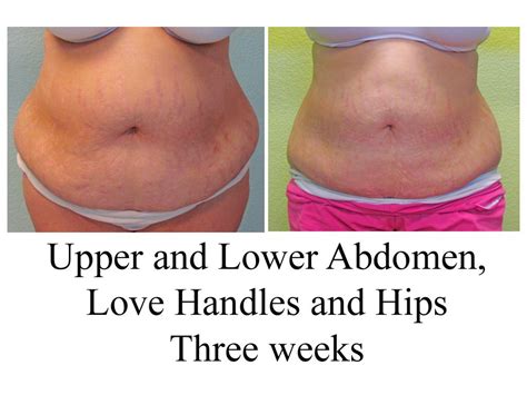 Our Liposuction Before And After Gallery Myshape Lipo Love Handles