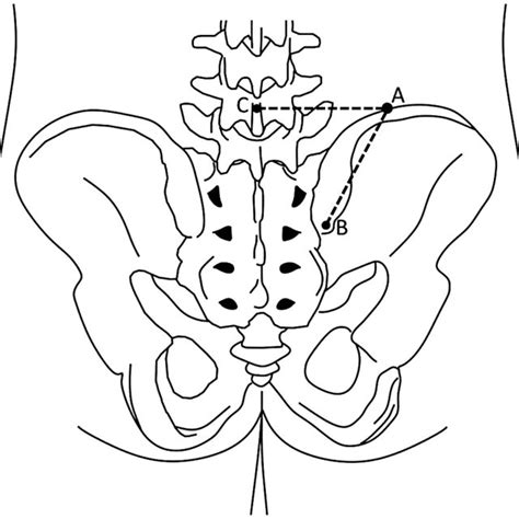 Line Diagram Of Back And Posterior Iliac Crest With The Point Where The