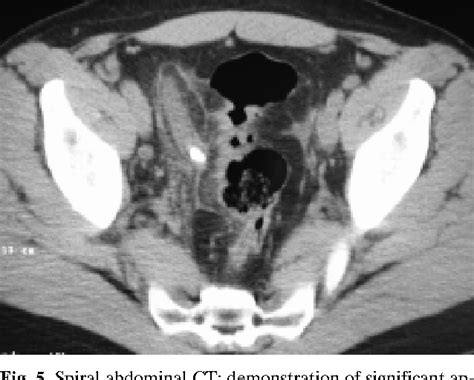 Pdf Acute Gangrenous Appendicitis Diagnosis By Spiral Ct Semantic