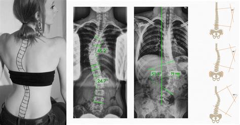 the different scoliosis locations and types of spinal curvatures treating scoliosis