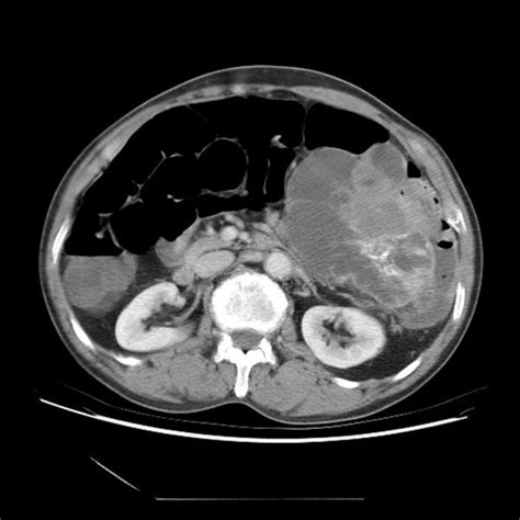 Colonoscopic Findings Showing A Necrotic Mass Protruding From The Colon