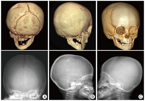 Depressed Skull Fracture In The Simple X Ray And 3 Dimensional Computed