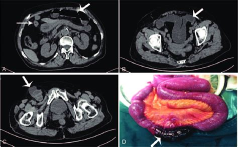 Description Of Emergency Surgery Of Igh This Was An 84 Year Old Female