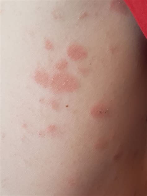 Dermatology Pictures Of Common Skin Rashes Medhelp Porn Sex Picture