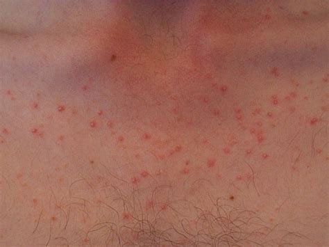 Acne Confused With Pityrosporum Folliculitis A Must Read For People