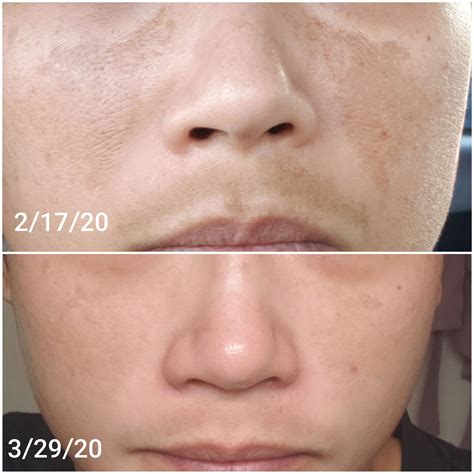 Dark Spot Correctorremover Hydroquinone Cream For Melasma The Spot