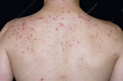 Acne Vulgaris On The Back Stock Image C0029558 Science Photo Library
