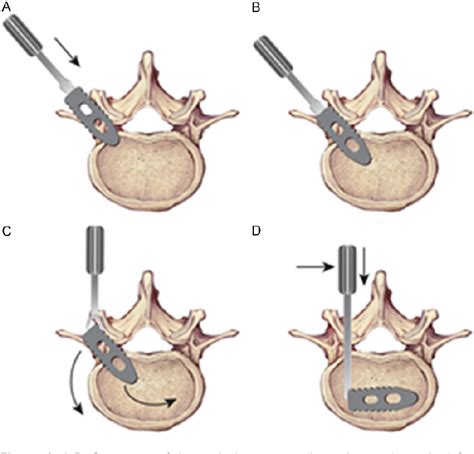 Figure 1 From Single Transverse Orientation Cage Via Mis Tlif Approach