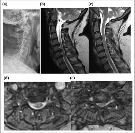 Figure 1 From Clinical Outcomes After Four Level Anterior Cervical