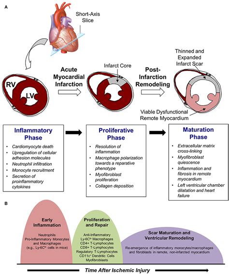 Pathophysiology Of A Myocardial Infarction