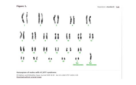 47 xyy syndrome pictures