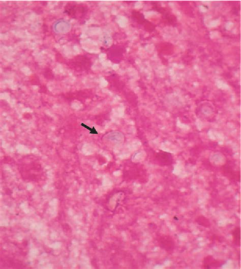 Figure 2 From Cervical Lymphadenitis Caused By Cryptococcus Related
