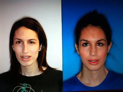Before And After Pictures Of Jaw Surgery Oral Surgery Boca Delray