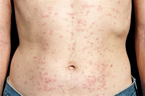 10 Common Bacterial Skin Infections