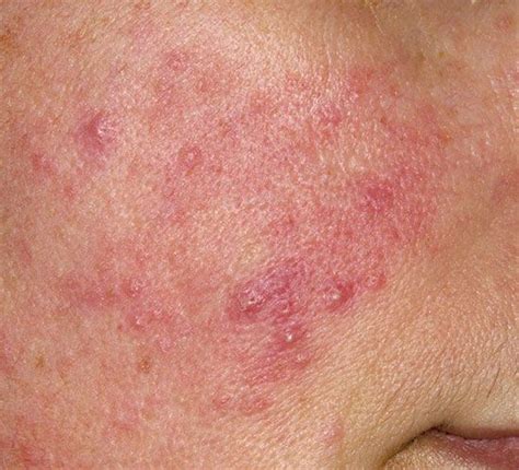12 Common Skin Problems And Solutions Rosacea Skin Care Skin
