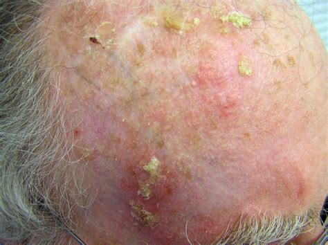 Actinic Keratosis And Skin Cancer
