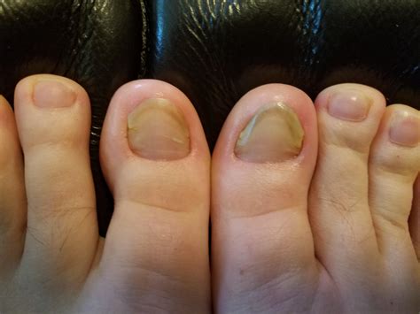 My Toenail Fungus Success Story With Before And After And Progress