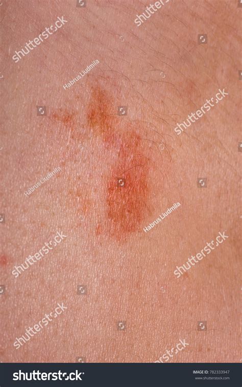 Great Red Spot On Skin Closeup Stock Photo 782333947 Shutterstock