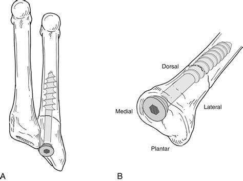 Open Reduction And Internal Fixation Of Proximal Fifth Metatarsal Fractures Musculoskeletal Key