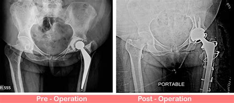 Uncemented Total Hip Replacement With Constrained Liner