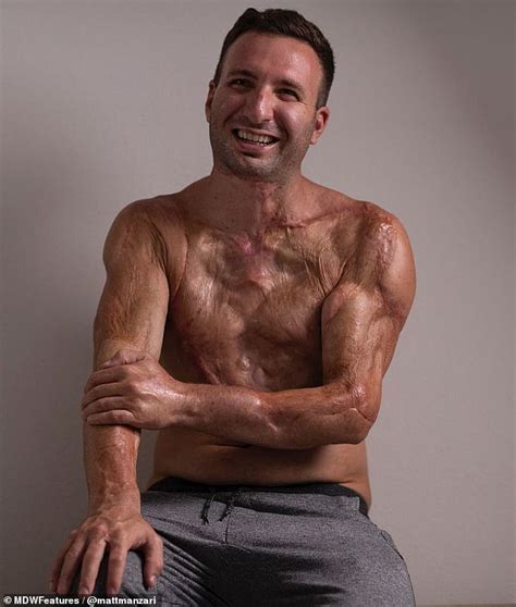 Mans Skin Melted After He Was Electrocuted By 14000 Volts Lifestylemed