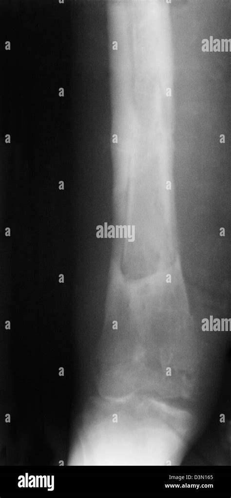X Ray Showing Osteomyelitis Of The Tibia From An Open Fracture Stock