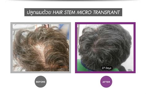 This is an important step forward in research to develop treatments for hearing loss, as cells in the adult inner ear do not naturally replace themselves. Breakthrough Stem Cell Treatment for Hair Loss - Apex ...