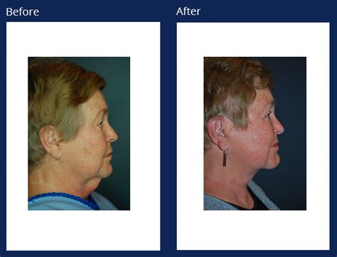 Facelift Holzapfel Lied Plastic Surgery