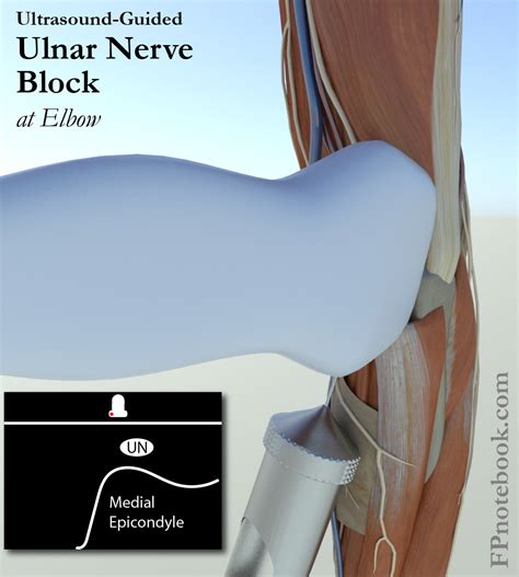 Ulnar Nerve Block At Elbow