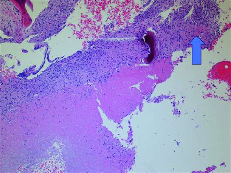 Necrotizing Granulomatous Inflammation Download Scientific Diagram