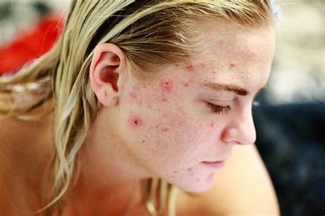Remove Acne Tips And Tricks Fast Treatment Care Get Rid Off Acne