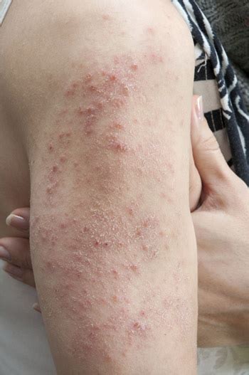Dermatologists Explain When To Seek Treatment For A Rash Outbreak