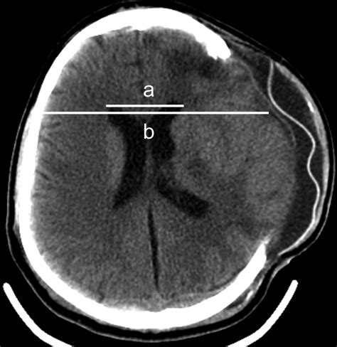 Factors Associated With Shunt Dependent Hydrocephalus After