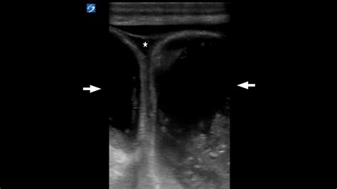 Incarcerated Inguinal Hernia Ultrasound