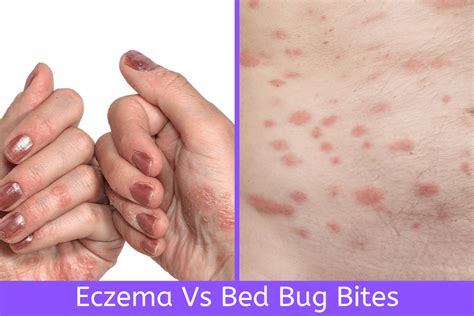 Eczema Vs Bed Bug Bites How To Tell The Difference Wpics