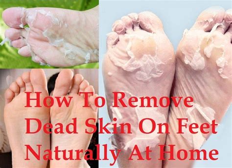 How To Remove Dead Skin On Feet Naturally At Home Dead Skin On Feet