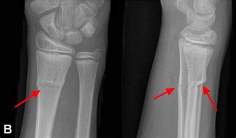 Greenstick Fracture Causes Healing Time Treatment