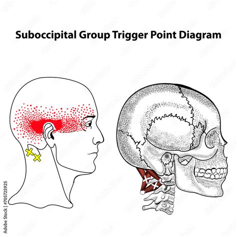 Suboccipital Group Trigger Point Diagram Trapezius Scm Levator