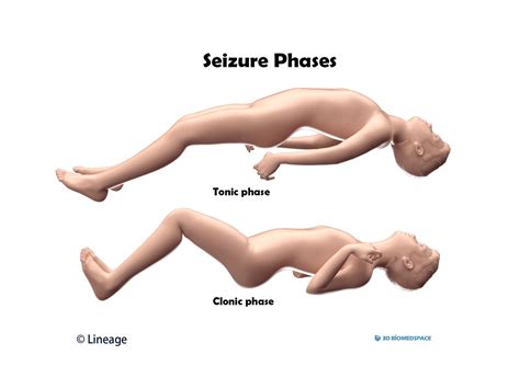 Seizure Causes What Does A Seizure Look Like