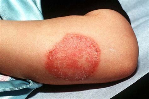 How To Treat Ringworm In Babies And Children Ethissa