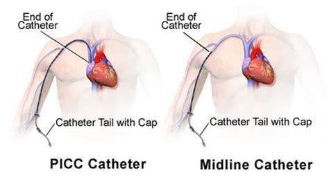 Types And Uses Of Iv Catheters For Humans General